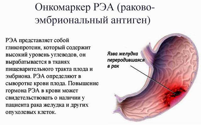 Онкомаркер рэа 19