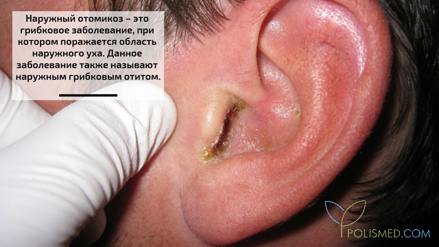 Наружный отомикоз