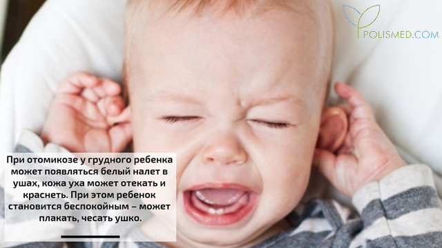 Отомикоз у грудничка