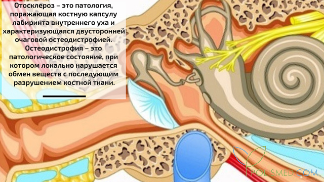Отосклероз