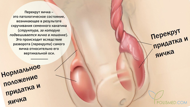 что делать если одно яйцо перекрутилось. Смотреть фото что делать если одно яйцо перекрутилось. Смотреть картинку что делать если одно яйцо перекрутилось. Картинка про что делать если одно яйцо перекрутилось. Фото что делать если одно яйцо перекрутилось