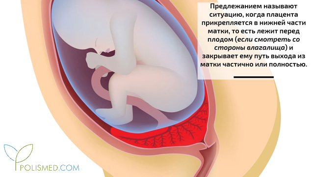 Плацента на рубце матки