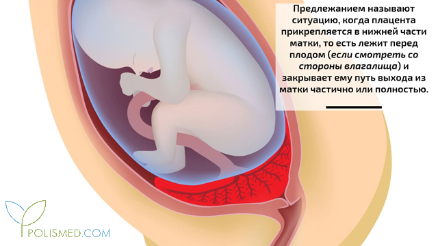 Плацента на рубце матки. Предлежание плаценты. Предлежание и отслойка плаценты. Предлежание плаценты с врастанием. Предлежание плаценты с врастанием в рубец.