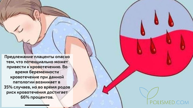 Последствия предлежания плаценты