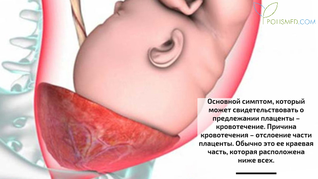 Признаки предлежания плаценты