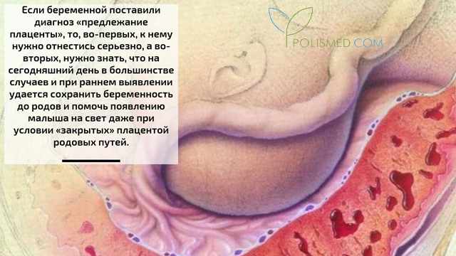 Действия при предлежании плаценты