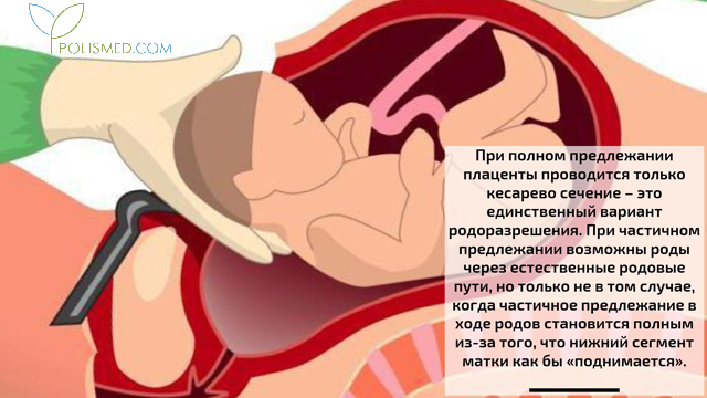 Роды при предлежании плаценты