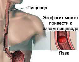 Болит желудок при эзофагите
