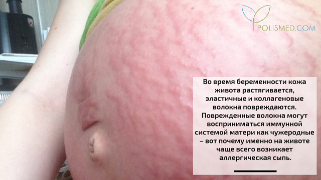 Кожа во время беременности