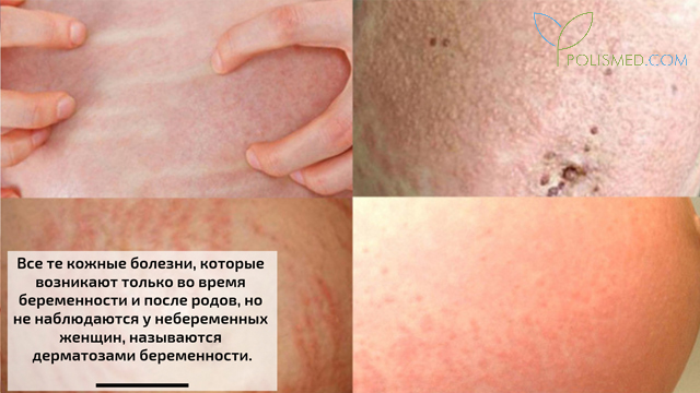 Причины сыпи при беременности