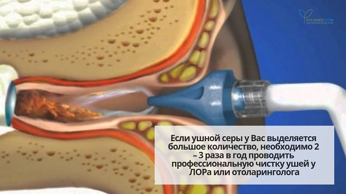 Профессиональная чистка уха от серы