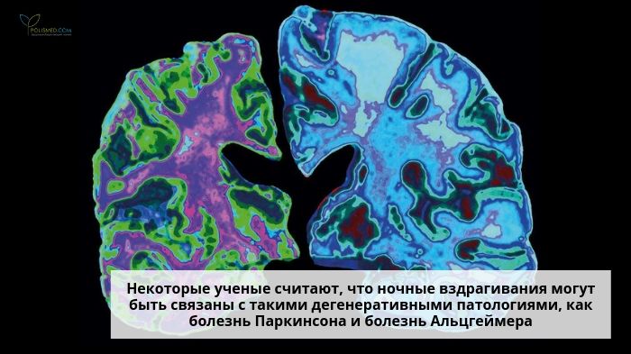 Мозг при болезни Альцгеймера