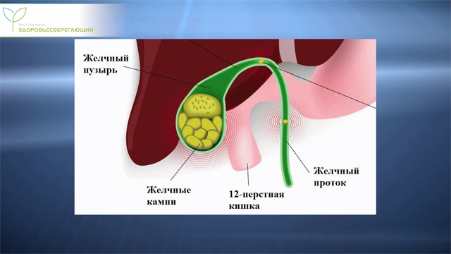 Желчные камни