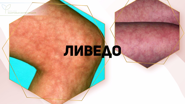 Что такое печеночная пигментация. Смотреть фото Что такое печеночная пигментация. Смотреть картинку Что такое печеночная пигментация. Картинка про Что такое печеночная пигментация. Фото Что такое печеночная пигментация