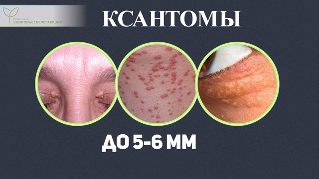 Что такое печеночная пигментация. Смотреть фото Что такое печеночная пигментация. Смотреть картинку Что такое печеночная пигментация. Картинка про Что такое печеночная пигментация. Фото Что такое печеночная пигментация