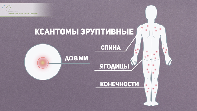 Что такое печеночная пигментация. Смотреть фото Что такое печеночная пигментация. Смотреть картинку Что такое печеночная пигментация. Картинка про Что такое печеночная пигментация. Фото Что такое печеночная пигментация