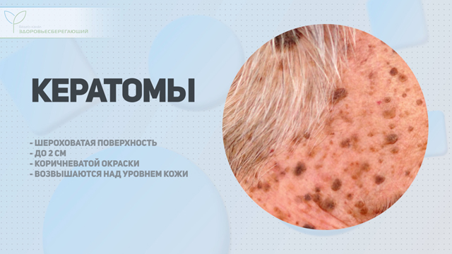 Что такое печеночная пигментация. Смотреть фото Что такое печеночная пигментация. Смотреть картинку Что такое печеночная пигментация. Картинка про Что такое печеночная пигментация. Фото Что такое печеночная пигментация