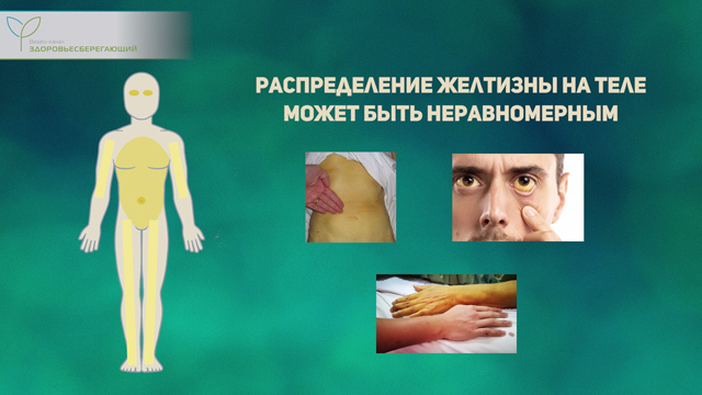 Что такое печеночная пигментация. Смотреть фото Что такое печеночная пигментация. Смотреть картинку Что такое печеночная пигментация. Картинка про Что такое печеночная пигментация. Фото Что такое печеночная пигментация