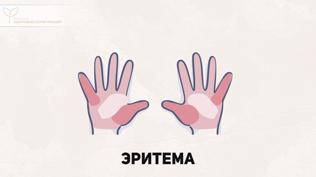 Что такое печеночная пигментация. Смотреть фото Что такое печеночная пигментация. Смотреть картинку Что такое печеночная пигментация. Картинка про Что такое печеночная пигментация. Фото Что такое печеночная пигментация