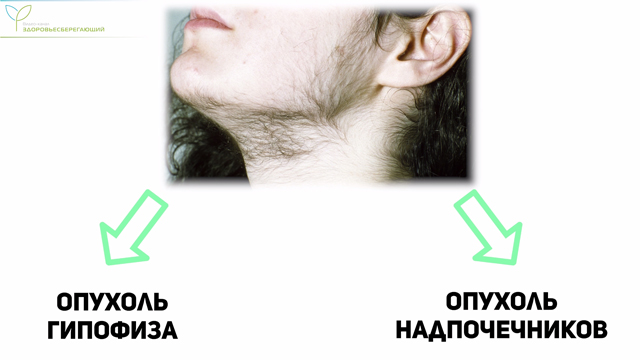 Следствие опухоли гипофиза либо надпочечников
