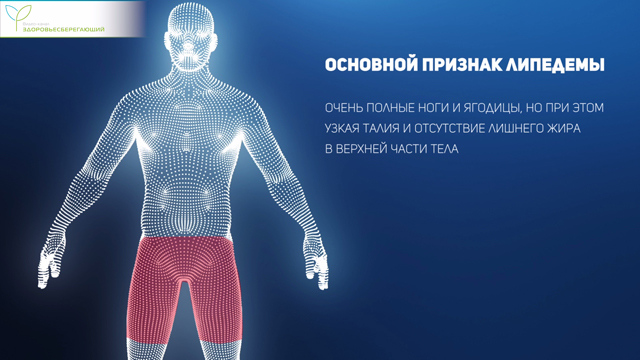 Признак липедемы