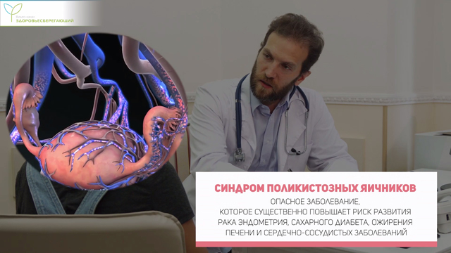 Синдром поликистозных яичников