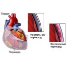 Перикардит