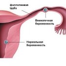 Внематочная беременность