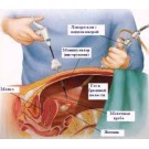 Лапароскопия