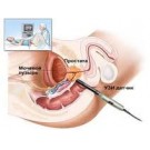 УЗИ предстательной железы (простаты)