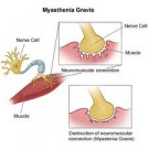 Миастения
