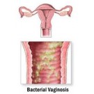 Бактериальный вагиноз