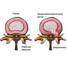 Грыжа межпозвоночного диска