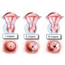 Дисплазия шейки матки