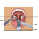 Удаление миндалин (тонзиллэктомия)