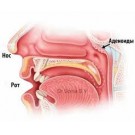 Аденоиды