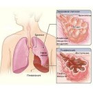 Воспаление легких (пневмония)