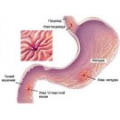Язвенная болезнь желудка и двенадцатиперстной кишки