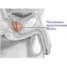 Рак предстательной железы (простаты)