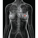Рак груди (рак молочной железы)