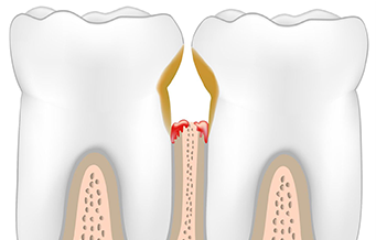 Пародонтоз